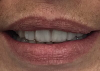 Dentures picture After treatment at beach denture clinic Toronto