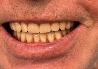 Dentures picture After treatment at beach denture clinic Toronto