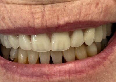 Dentures picture after treatment at beach denture clinic Toronto