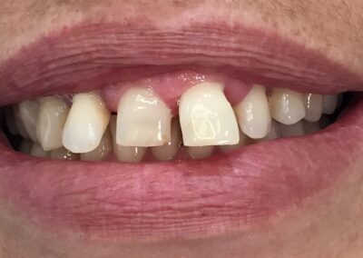 Dentures picture before treatment at beach denture clinic Toronto