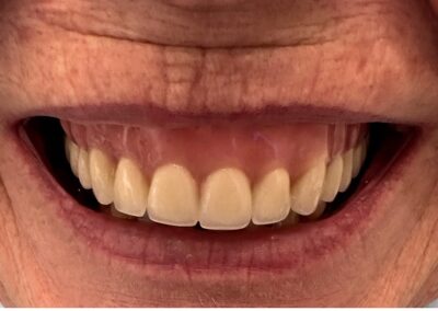 Dentures picture before treatment at beach denture clinic Toronto